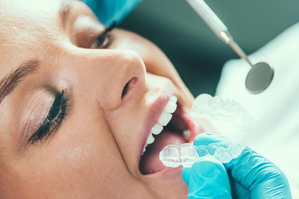 Tooth Whitening Procedure