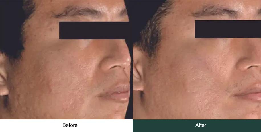Microneedling men chick before after