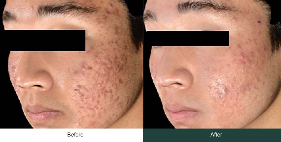 Microneedling men pimple before after