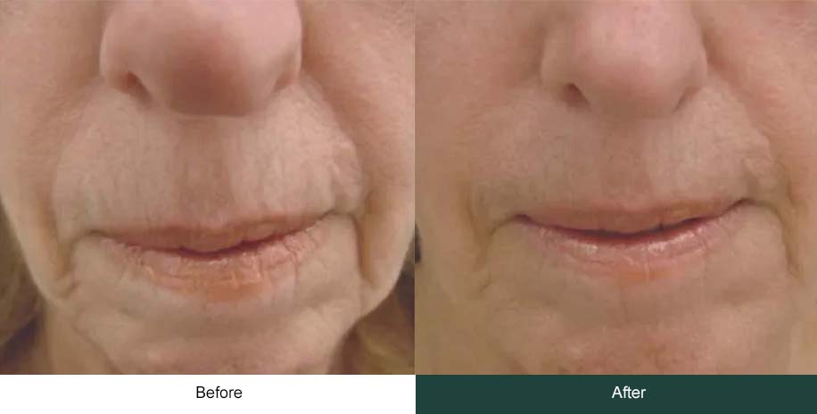 Micro needling old women mouth before after