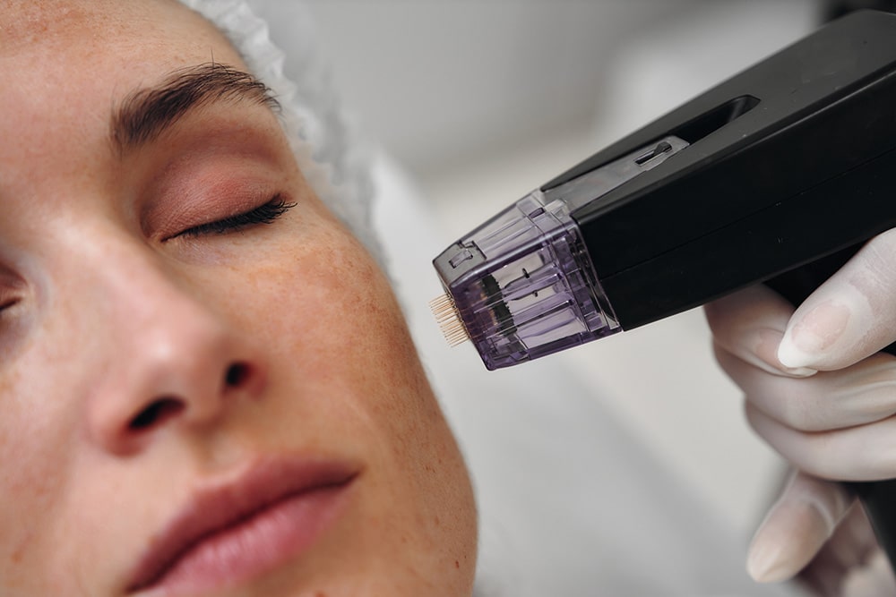 Salmon DNA Microneedling